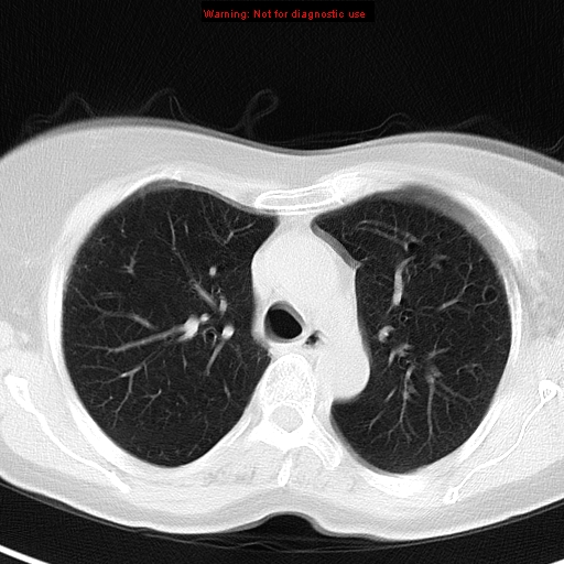 File:Bronchoalveolar carcinoma (BAC) (Radiopaedia 13436-13392 Axial lung window 17).jpg