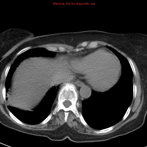 File:Bronchoalveolar carcinoma (BAC) (Radiopaedia 13436-13392 Axial non-contrast 40).jpg