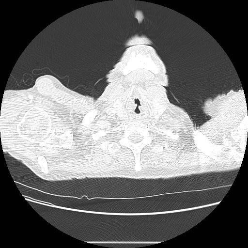 Bronchocele (Radiopaedia 17097-16795 Axial lung window 2).jpg