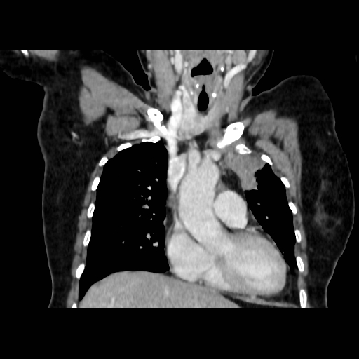 Bronchogenic carcinoma (Radiopaedia 73497-84262 C 51).jpg