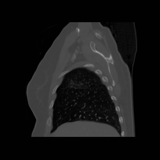 Bronchogenic carcinoma (Radiopaedia 73497-84262 Sagittal bone window 38).jpg