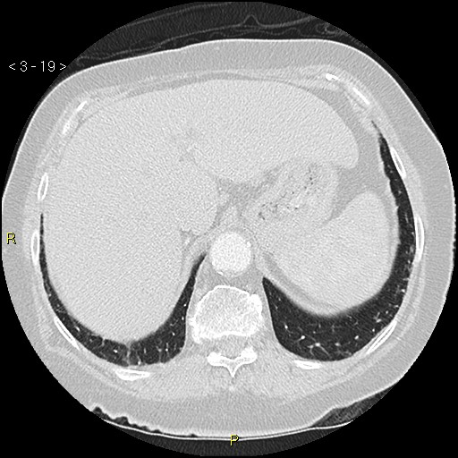 Bronchogenic carcinoma as an incidental finding (Radiopaedia 16453-16130 Axial lung window 19).jpg