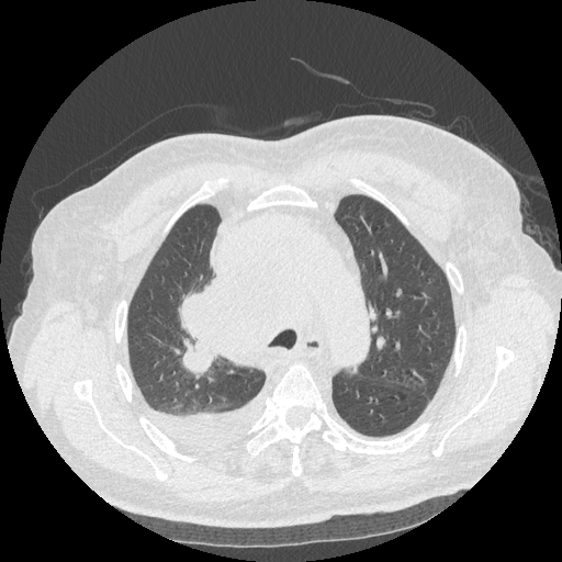Bronchogenic carcinoma with metastatic lymphadenopathy (Radiopaedia 37671-39569 Axial lung window 17).jpg