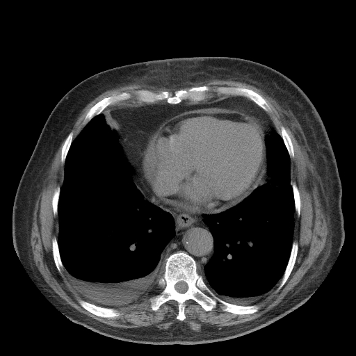 File:Bronchogenic carcinoma with metastatic lymphadenopathy (Radiopaedia 37671-39569 Axial non-contrast 39).jpg