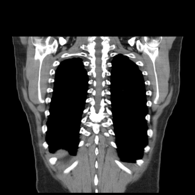 Bronchogenic carcinoma with upper lobe collapse (Radiopaedia 29297-29726 D 46).jpg