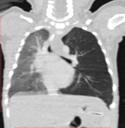 Bronchogenic cyst (Radiopaedia 78599-91409 Coronal lung window 125).jpg