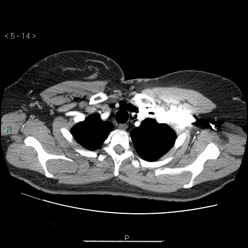 Bronchogenic cyst - posterior mediastinal (Radiopaedia 43885-47364 A 8).jpg