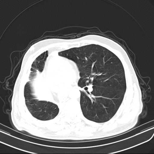 Bronchopleural fistula - postoperative complication (Radiopaedia 21020-20947 Axial lung window 31).jpg