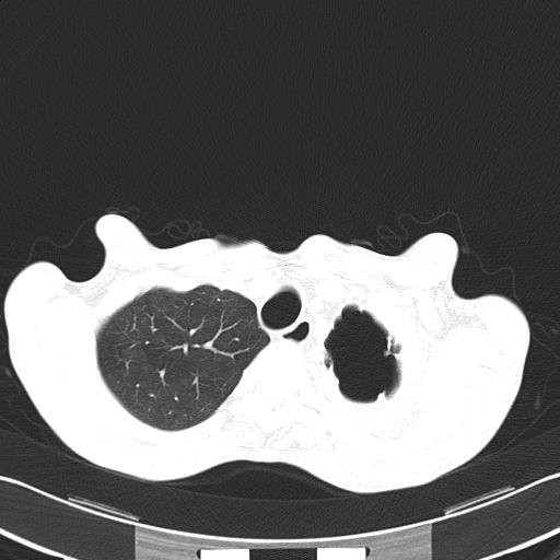 Bronchopleural fistula secondary to tuberculosis (Radiopaedia 20415-20322 Axial lung window 12).jpg