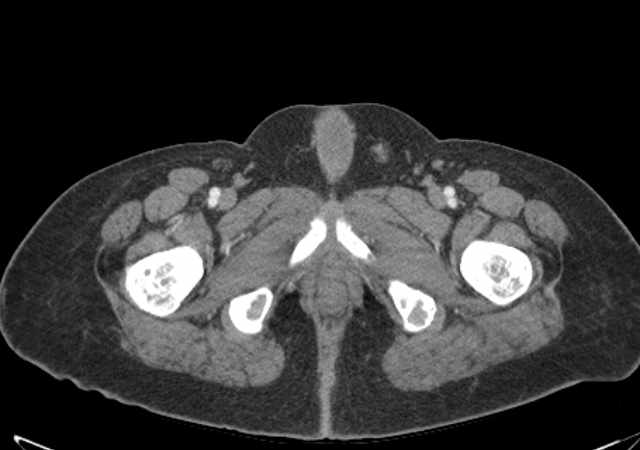Brown tumors compressing the spinal cord (Radiopaedia 68442-77988 E 134).jpg