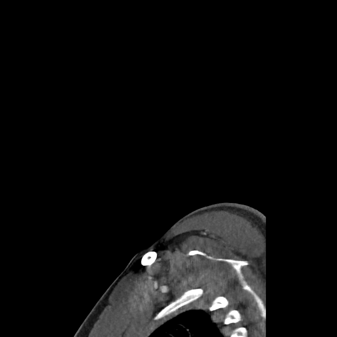 Buccal fat pad arteriovenous malformation (Radiopaedia 70936-81144 C 13).jpg