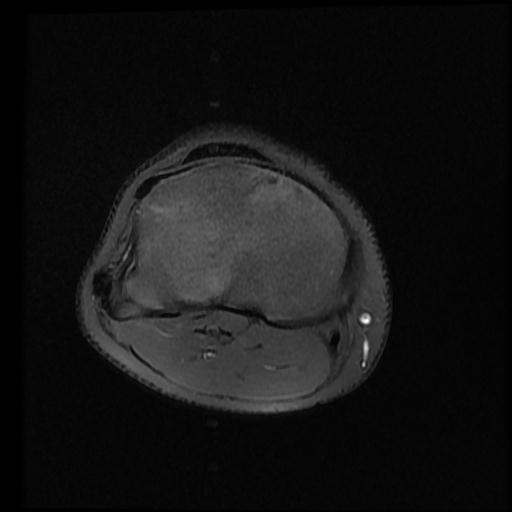 File:Bucket handle tear - lateral meniscus (Radiopaedia 72124-82634 Axial PD fat sat 13).jpg