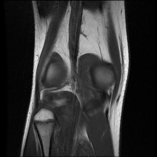 File:Bucket handle tear - lateral meniscus (Radiopaedia 72124-82634 Coronal T1 14).jpg