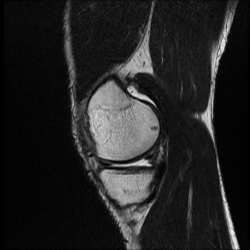 File:Bucket handle tear - medial meniscus (Radiopaedia 69245-79026 Sagittal T2 17).jpg