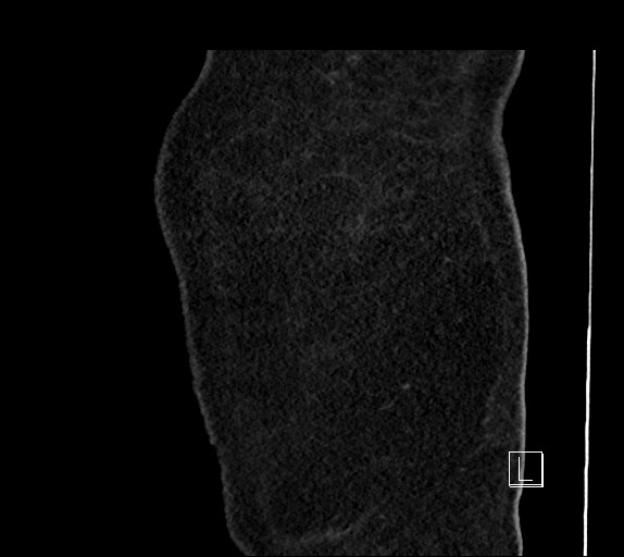 Buried bumper syndrome - gastrostomy tube (Radiopaedia 63843-72577 Sagittal Inject 120).jpg