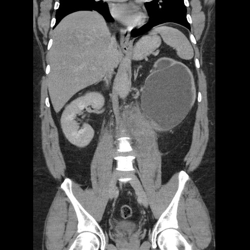Burned-out testicular seminoma - retroperitoneal nodal metastases (Radiopaedia 62872-71245 B 40).jpg