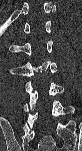 Burst fracture (Radiopaedia 53373-59357 Coronal bone window 50).jpg