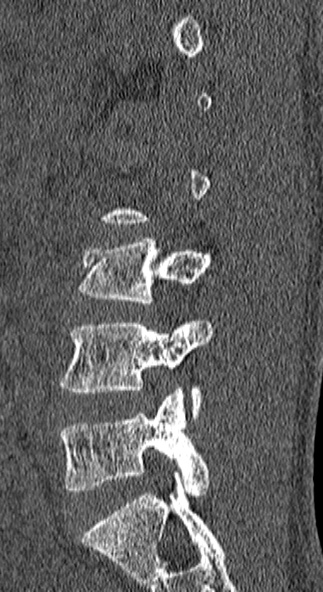 Burst fracture (Radiopaedia 53373-59357 Sagittal bone window 60).jpg