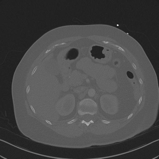 Burst fracture - thoracic spine (Radiopaedia 30238-30865 Axial bone window 97).jpg