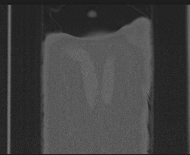 Burst fracture - thoracic spine (Radiopaedia 30238-30865 Coronal bone window 161).jpg