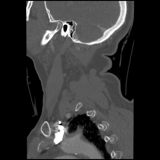 File:C1 anterior arch (plough) fracture - type 1 (Radiopaedia 76181-87720 Sagittal bone window 24).jpg
