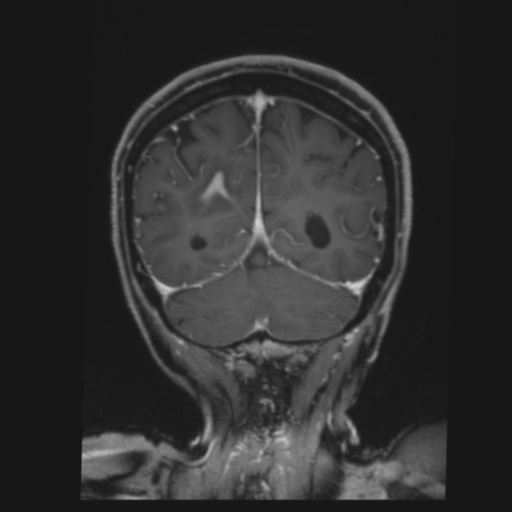 CNS lymphoma with steroid response (Radiopaedia 37980-39921 Coronal T1 C+ 38).png