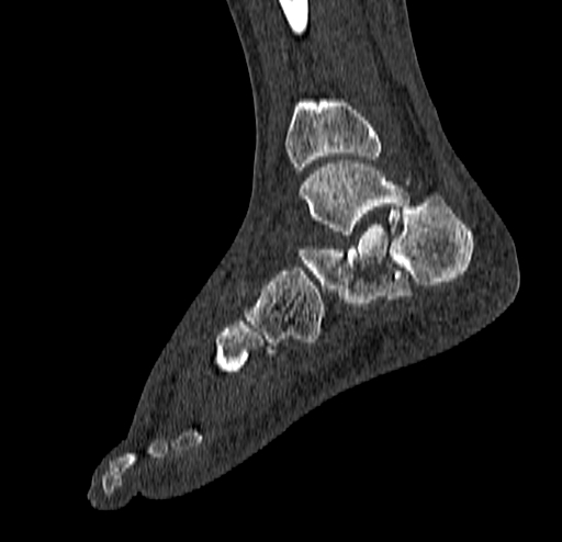 Calcaneal fracture - Sanders type 4 (Radiopaedia 90179-107370 Sagittal bone window 57).jpg