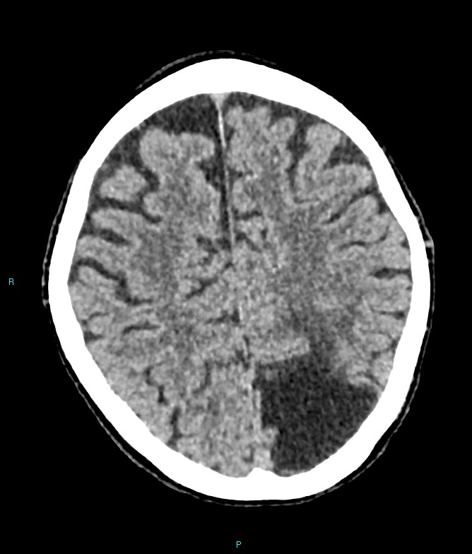 Calcified cerebral emboli from left ventricular thrombus (Radiopaedia 84420-99758 Axial non-contrast 30).jpg
