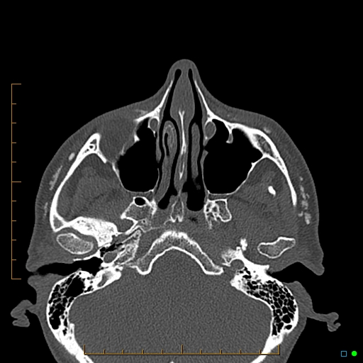 Calcified facial augmentation fillers (Radiopaedia 79514-92679 Axial bone window 16).jpg