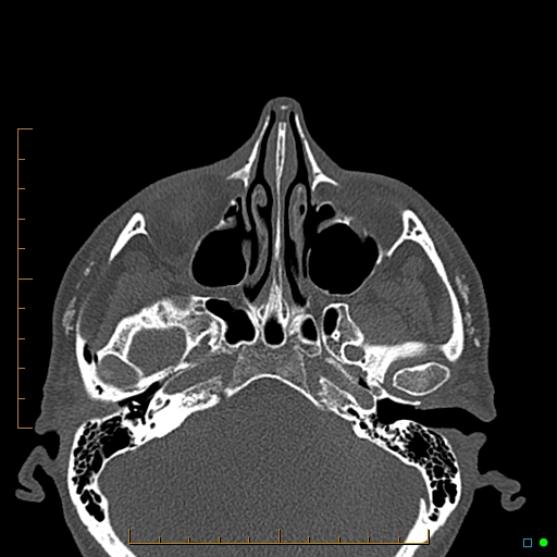 Calcified facial augmentation fillers (Radiopaedia 79514-92679 Axial bone window 8).jpg