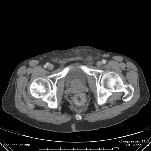 Calcified liver metastases (Radiopaedia 44699-48470 B 63).jpg
