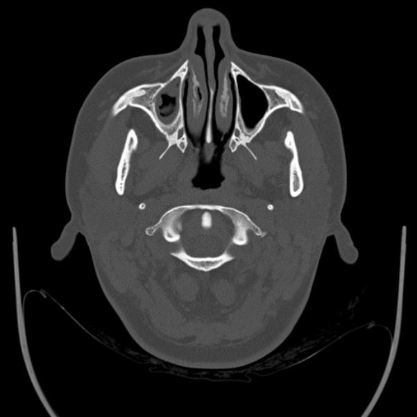 Calvarial osteoma (Radiopaedia 36520-38079 Axial bone window 6).jpg