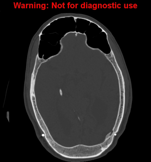 File:Calvarial thickening from chronic shunting (Radiopaedia 60079-67637 Axial bone window 85).jpg