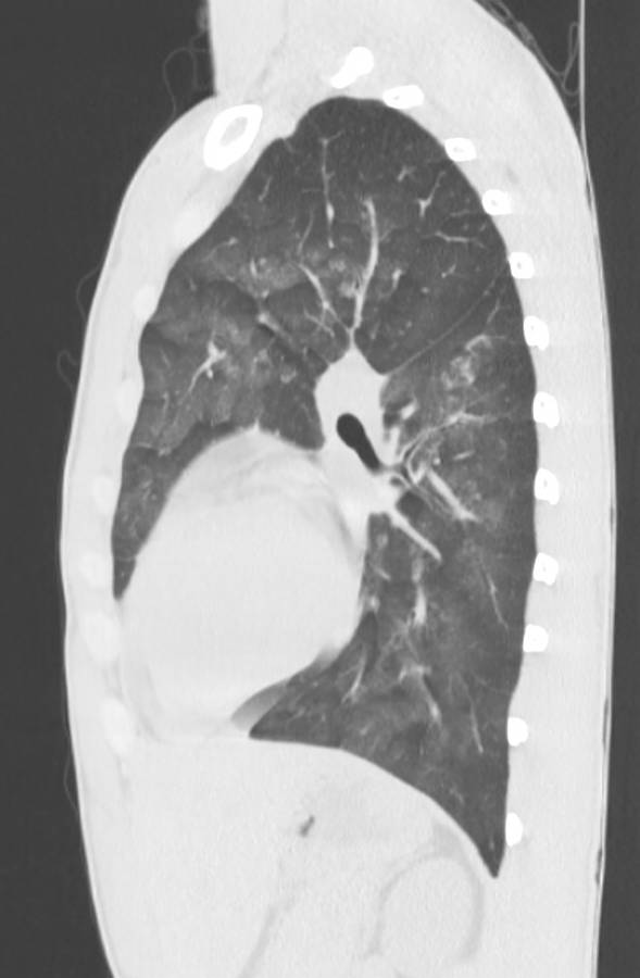 Cannabis-induced diffuse alveolar hemorrhage (Radiopaedia 89834-106946 Sagittal lung window 91).jpg