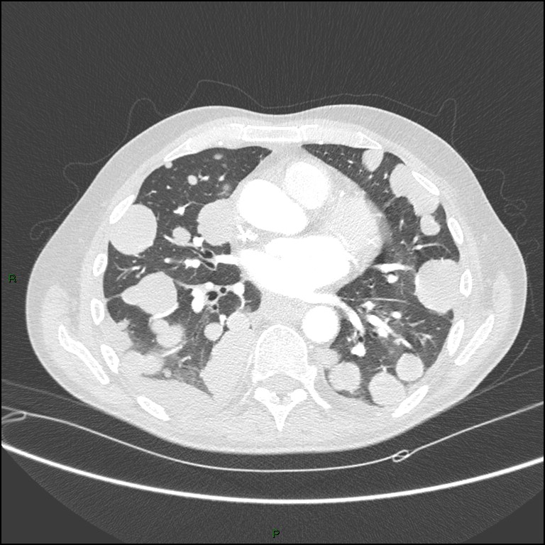 Cannonball metastases (Radiopaedia 82110-96150 Axial lung window 112).jpg