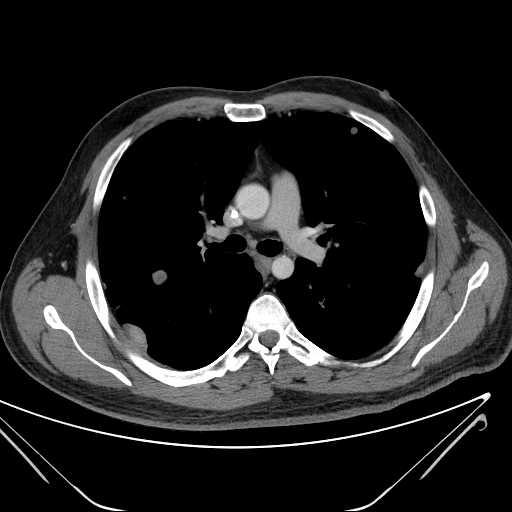 File:Cannonball pulmonary metastases (Radiopaedia 67684-77101 D 117).jpg