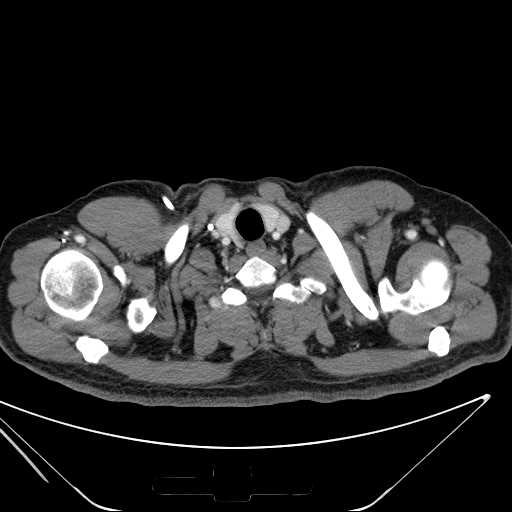 File:Cannonball pulmonary metastases (Radiopaedia 67684-77101 D 3).jpg