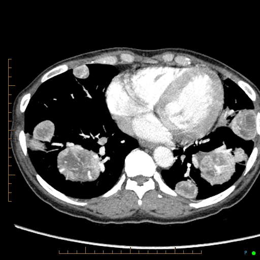 Canonball lung metastasis (Radiopaedia 77634-89837 B 71).jpg