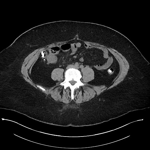 Carcinoid tumor - terminal ileum (Radiopaedia 60931-68740 Axial non-contrast 72).jpg