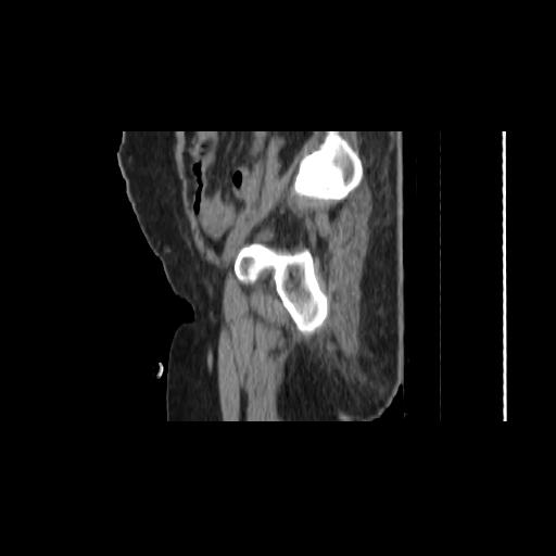 Carcinoma cervix- brachytherapy applicator (Radiopaedia 33135-34173 D 30).jpg