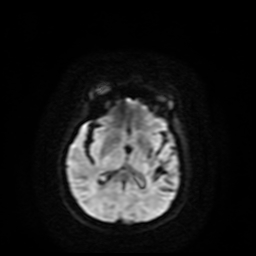 Carcinoma ex-pleomorphic adenoma of parotid (Radiopaedia 28383-28627 Ax DWI B-500 GE 73).jpg