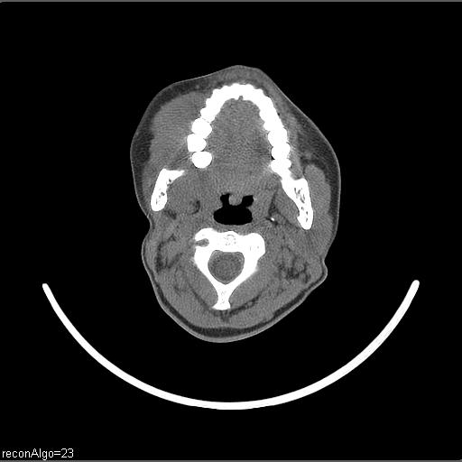 Carcinoma of the maxillary antrum (Radiopaedia 53805-59888 Axial non-contrast 47).jpg