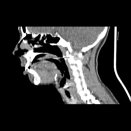 Carcinoma of the maxillary antrum (Radiopaedia 53805-59888 Sagittal C+ delayed 103).jpg