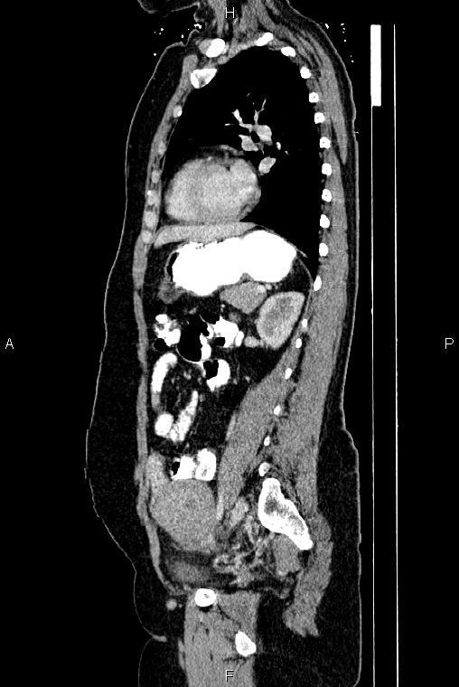 Carcinoma of uterine cervix (Radiopaedia 85861-101700 D 55).jpg