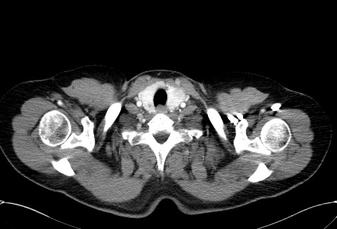 Cardiac sarcoidosis (Radiopaedia 74548-85534 A 1).jpg