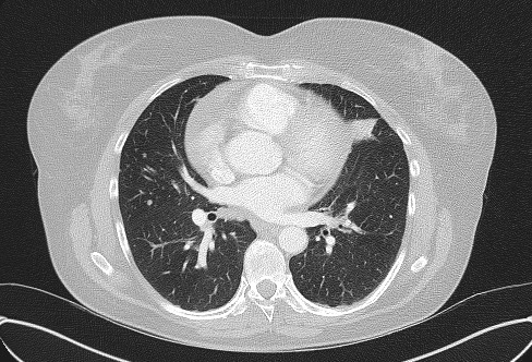 File:Cardiac sarcoidosis (Radiopaedia 74548-85534 Axial lung window 46).jpg