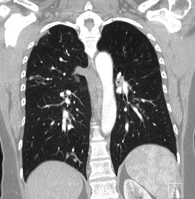 Cardiac sarcoidosis (Radiopaedia 74548-85534 Coronal lung window 45).jpg