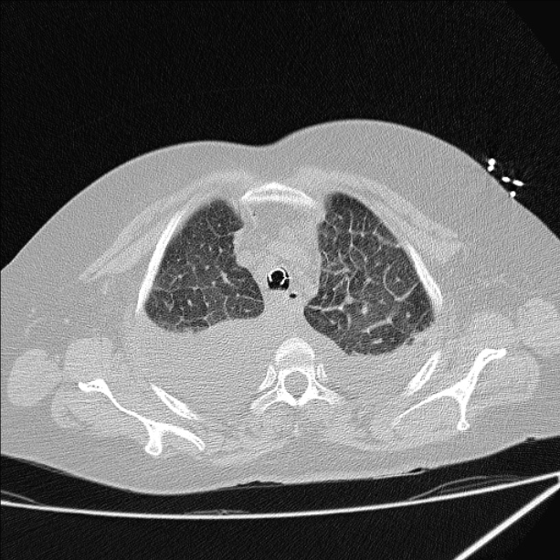 Cardiogenic pulmonary edema (Radiopaedia 29213-29609 Axial lung window 15).jpg