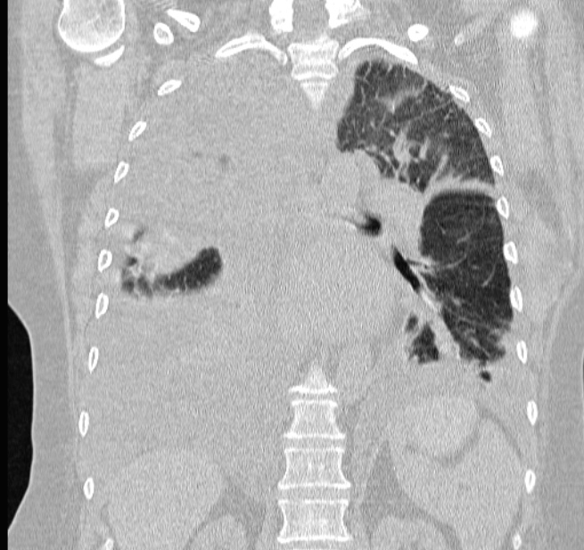 Cardiogenic pulmonary edema (Radiopaedia 29213-29609 Coronal lung window 44).jpg