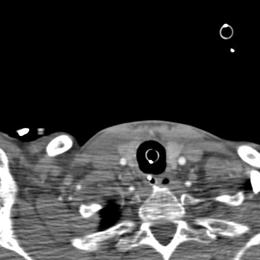 File:Carotid arterial dissection (Radiopaedia 30001-30548 B 32).jpg